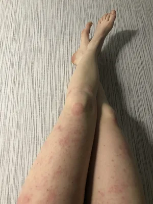 Лекарственная аллергия - лечение в Ростове-на-Дону