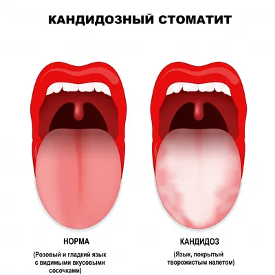 Гастроэнтеролог предупредила об опасности белого и желтого налета на языке:  Уход за собой: Забота о себе: Lenta.ru