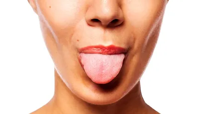 Наросты на языке в полости рта