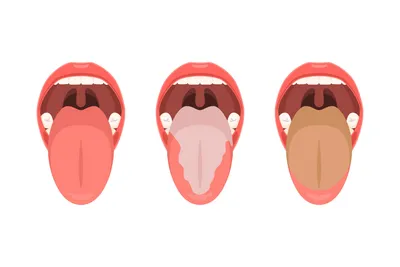 Что цвет налета на языке говорит о вашем здоровье?: Расшифровка симптомов |  Диетолог Николай Тихенко | Дзен