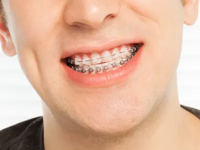 Керамические брекеты под цвет зубов | Статьи клиники эстетической  стоматологии Vimontale