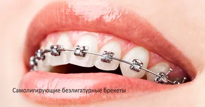 Безлигатурные брекеты: преимущества и эффективность лечения - клиника  Ортодонтика, Москва