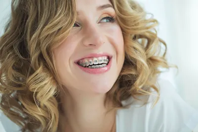 Самолигирующие брекет системы — ОртоСмайл — стоматология для всей семьи