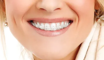 10 причин поставить брекеты во взрослом возрасте – мнение стоматологов