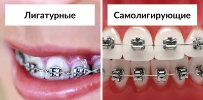 Брекеты на верхнюю челюсть в Омске, цены на установку в стоматологии  «Ортодонт-центр»