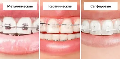 Выравнивание зубов брекетами у взрослых и детей, отзывы, цена доступная в  клинике VITART