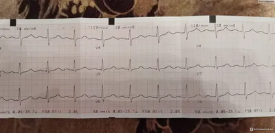 Как научиться читать ЭКГ