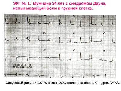 Примеры ЭКГ с расшифровкой кардиология , терапия , сердечно сосудистая  система | Шпаргалки Кардиология | Docsity
