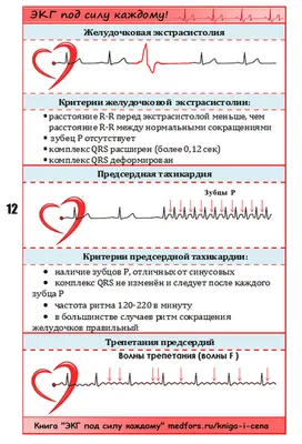 Абсолютно новая Шпора по ЭКГ | Медфорс