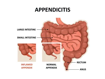 Признаки аппендицита и его лабораторная диагностика