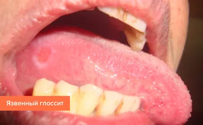 Основные симптомы воспаление языка (глоссита), виды, лечение – Стоматология  «АльфаДент» в Оренбурге