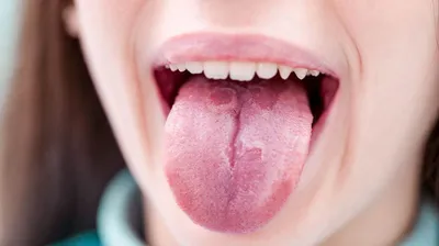 Глоссит языка у детей: симптомы и лечение - SHiFA