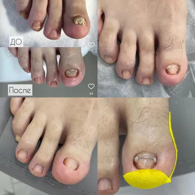 ⭐ Эффективное лечение грибка ногтей на ногах - podonails.com