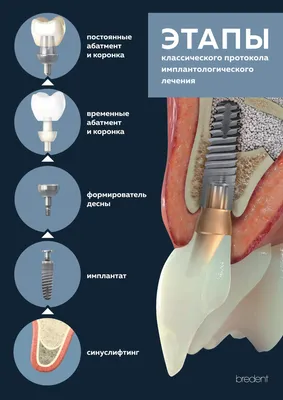 Имплантация зубов в Киеве – Стоимость и отзывы ᐈ Certus | Certus