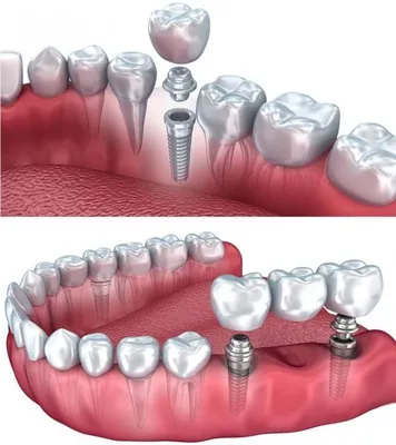 Имплантация зубов - стоит ли делать? - Cтоматология Май