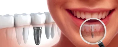 Безболезненная имплантация зубов в стоматологии