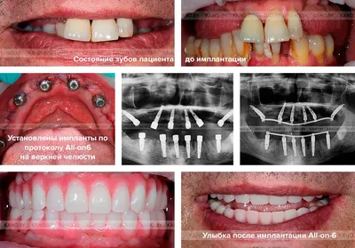 Имплантация зубов под ключ в Красноярске - Акция - клиника стоматологии МАРТ