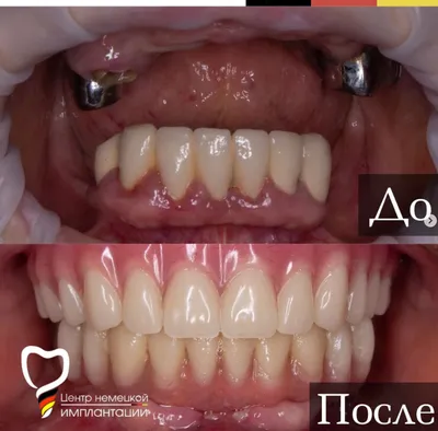 Имплантация зубов в Киеве — зубные импланты цена