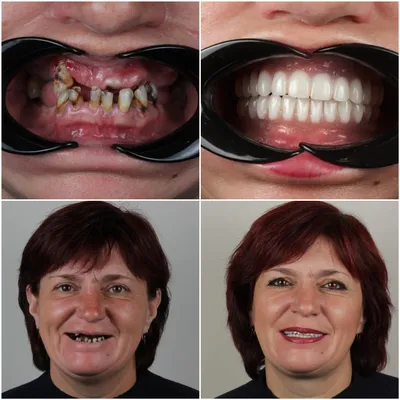 Имплантация зубов Днепр: цена имплантации 1 зуба под ключ