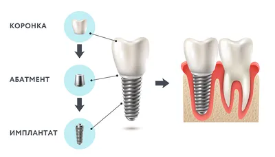 Имплантация зубов в Курске | Стоимость имплантации зубов