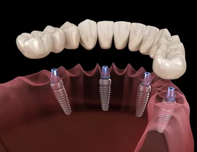 Имплантация зубов под ключ, акции, скидки | НоваДент