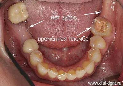 Полезный гид по имплантации зубов