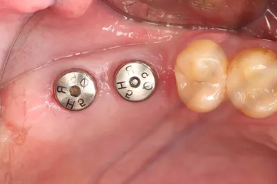 Имплантация двух нижних зубов с пластикой мягких тканей