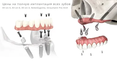 Имплантация зубов в Новосибирске - Videdent.ru