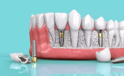 Имплантация зубов картинки фотографии