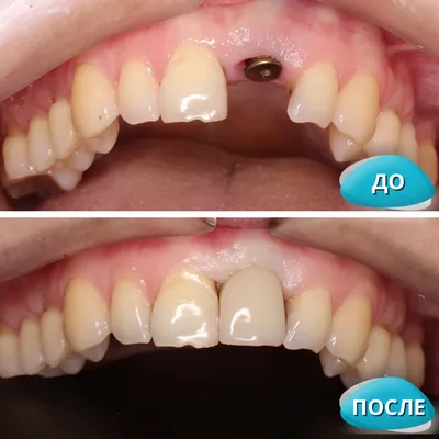 Имплантация зубов в Томске в Томске