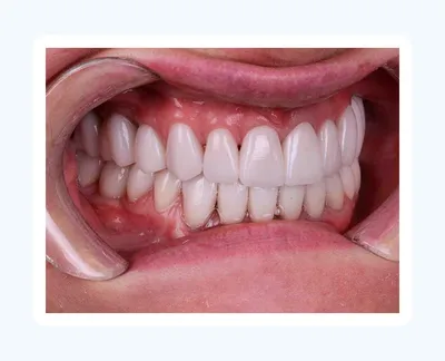 Имплантация зубов - технология осуществления | Стоматология «Интерстом»