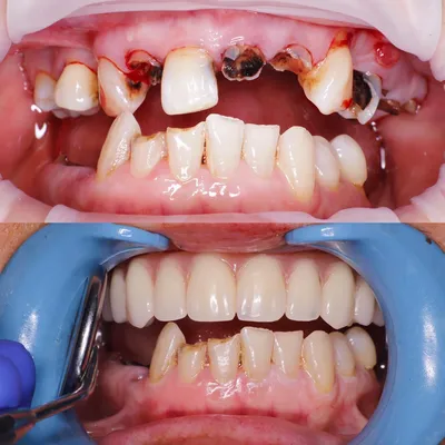 ᐉ Имплантация зубов «Под ключ» 【Цена ~ 18699 грн.】 в Декабре 2023 |  Стоматология «Бланко» Днепр