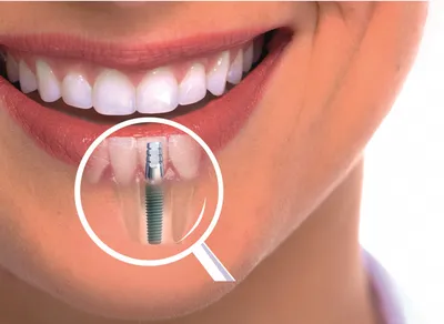 Имплантация зубов в Перми - цена от 28000 на имплант зуба установка под  ключ в стоматологии «ЭСТ»