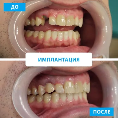 Протезирование и имплантация зубов в Барнауле от стоматологического центра  «Аполлония»
