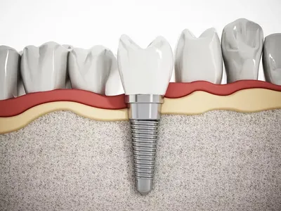 Имплантация зубов в СПБ - Цена на зубные импланты с установкой