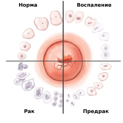 Причины, симптомы и методы лечения эрозии шейки матки