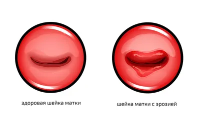 Лечение эрозии шейки матки в Хабаровске в Медикъ