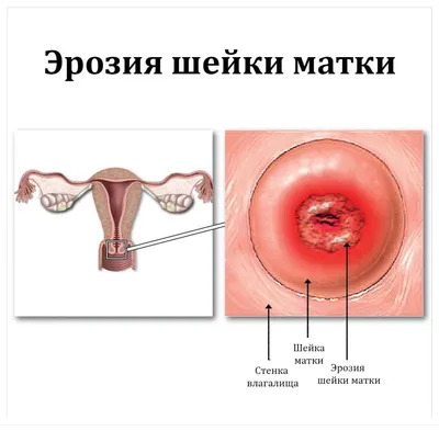 Последствия прижигания эрозии шейки матки | Анна-Мария Кравченко | Дзен