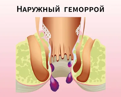 Геморрой, Лечение геморроя в Ташкенте | Клиника Medimax в Ташкенте