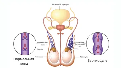 Варикоцеле (варикоз яичек) лечение в Украине | Клиника Биляка