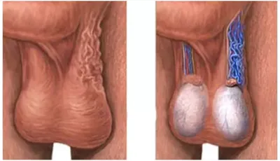 Операция по удалению у мужчин варикоцеле в Москве