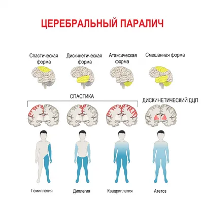 Применение физических упражнений в коррекции двигательных нарушений у детей  со спастической формой ДЦП – тема научной статьи по клинической медицине  читайте бесплатно текст научно-исследовательской работы в электронной  библиотеке КиберЛенинка