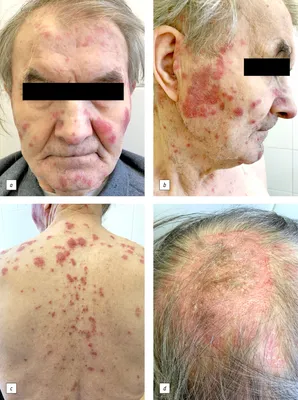 Сlinical cases of newly diagnosed systemic lupus erythematosus at the  appointment with a dermatologist - Morozova - Russian Journal of Skin and  Venereal Diseases