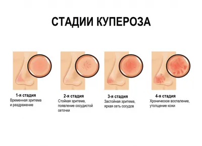 КУПЕРОЗ (сосудистые звёздочки на лице): причины, лечение, профилактика |  Амина Пирманова | Дзен