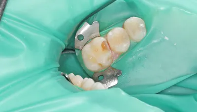 Лечение кариеса зубов: цена на установку пломбы | Лечение начального  (раннего) кариеса без анестезии
