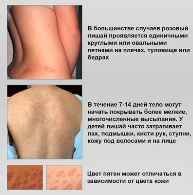 Лечение опоясывающего лишая, запись на прием в Нижнем Новгороде | ТОНУС ЛАЙФ