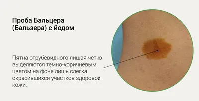 Некоторые кожные болезни: отрубевидный и розовый лишай