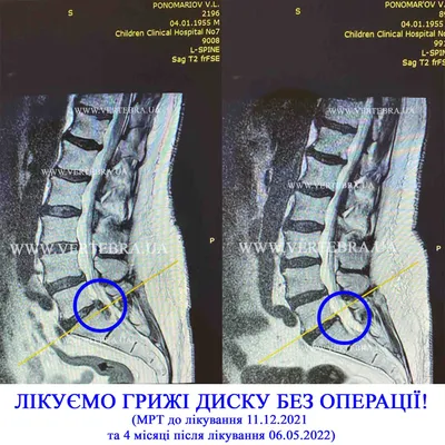 Грыжа поясничного отдела позвоночника: симптомы и лечение в Центре доктора  Бубновского на Авиамоторной