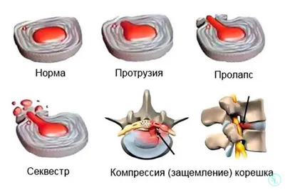 Межпозвонковая грыжа. Лечение грыжи позвоночника без операции в Киеве. -  Vertebra