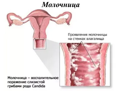 Молочница у мужчин: лечение молочницы у мужчин, симптомы кандидоза у мужчин  | doc.ua